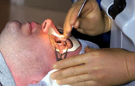 Szkleroplasztika rövidlátás esetén a látás stabilizálása érdekében