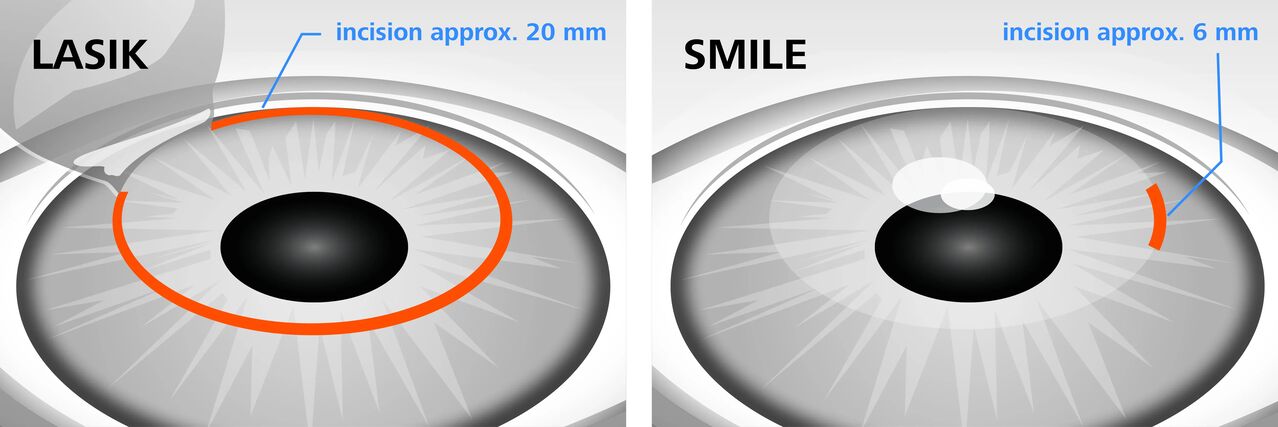 A LASIK és a SMILE lézeres látásjavító módszerek összehasonlítása